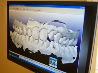 dental impressions digital