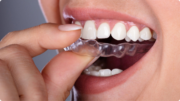 Splints and Appliances, Clear Sequential Aligners, Invisalign, Invisalign  Braces
