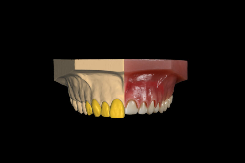 Exocad against veneers on model.